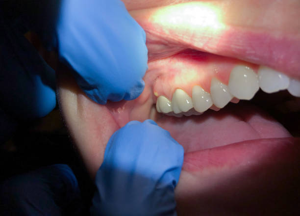 Best Emergency Treatment for Oral Infections in Willits, CA